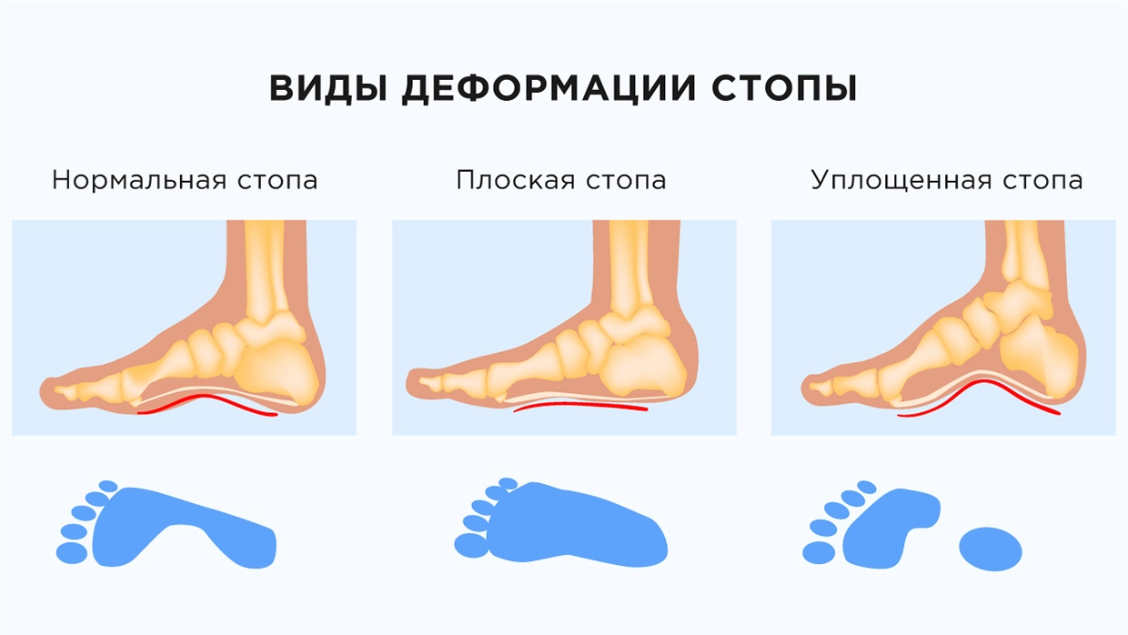 Деформация стопы - причины, диагностика и лечение